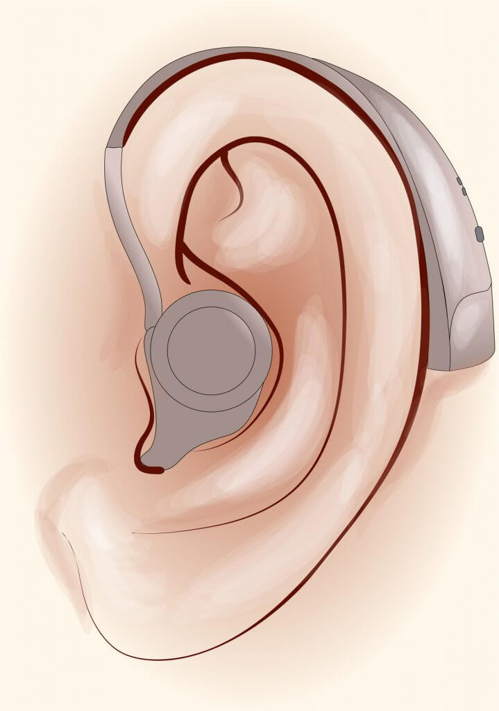 補聴器が広まらない理由と、そのデメリットについて。