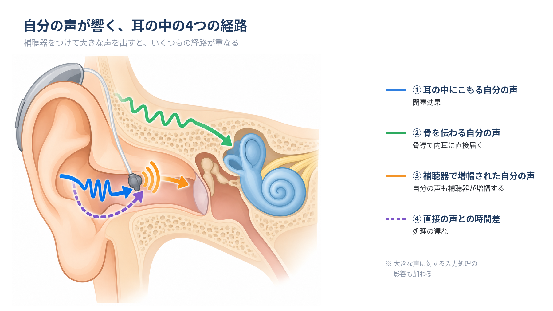 補聴器装用時に自分の声が響く経路（閉塞効果・骨導・補聴器の増幅音・処理の遅れ）を示す耳の断面イラスト