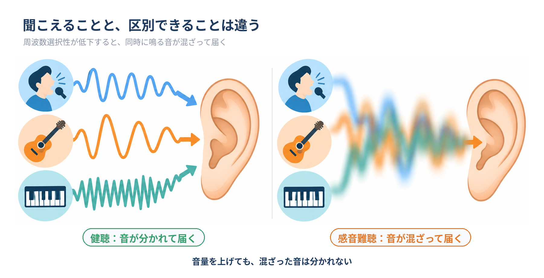 健聴ではボーカル・ギター・キーボードの音が分かれて届き、感音難聴では混ざって届くことを示すイラスト